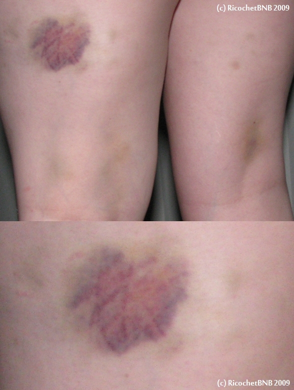 Bruises from first days of bocking...