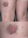 Bruises from first days of bocking...