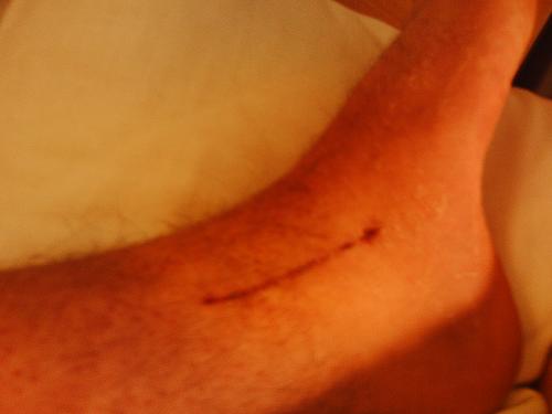 My scar
